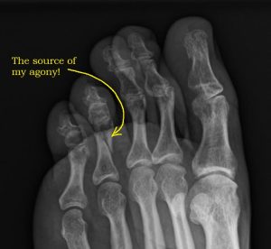 toe with arrow